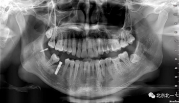 多學科病例分析---正畸、種植、微創拔牙多學科交叉病例