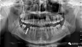 多學科病例分析---正畸、種植、微創拔牙多學科交叉病例