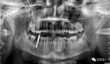 多學科病例分析---正畸、種植、微創拔牙多學科交叉病例