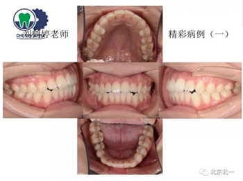 多學科病例分析---正畸、種植、微創拔牙多學科交叉病例