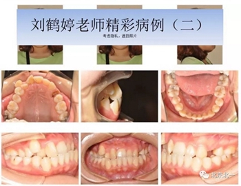 多學科病例分析---正畸、種植、微創拔牙多學科交叉病例