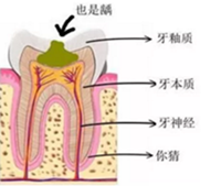 當心“腹黑”齲齒，牙齒有個小洞也要補！