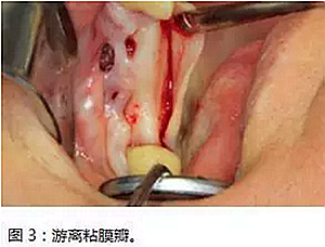 上頜竇瘺修補術——改良式旋轉帶蒂粘膜瓣修補術的應用
