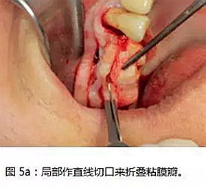 上頜竇瘺修補術——改良式旋轉帶蒂粘膜瓣修補術的應用