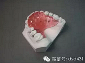 是什么導(dǎo)致了義齒返工？？？