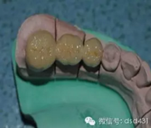 是什么導(dǎo)致了義齒返工？？？