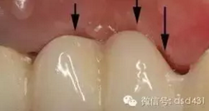 是什么導(dǎo)致了義齒返工？