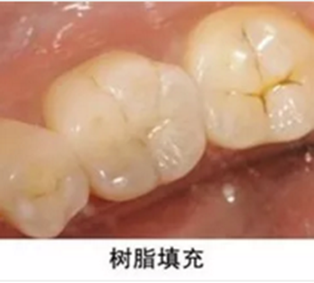 完全不懂，各種補牙材料，到底怎么選？