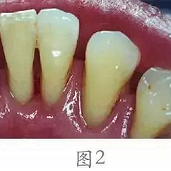 	 牙齦碰不得，一碰就出血。這是咋回事？