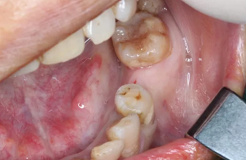 【病例分享】Implant Guide?數(shù)字化全程導航及椅旁即刻修復一例