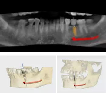 【病例分享】Implant Guide?數(shù)字化全程導航及椅旁即刻修復一例