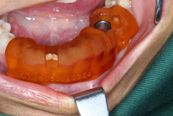 【病例分享】Implant Guide?數(shù)字化全程導航及椅旁即刻修復一例