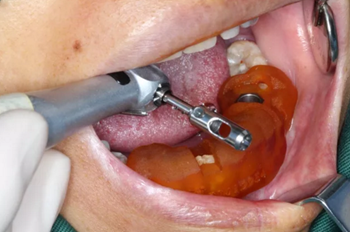 【病例分享】Implant Guide?數(shù)字化全程導航及椅旁即刻修復一例