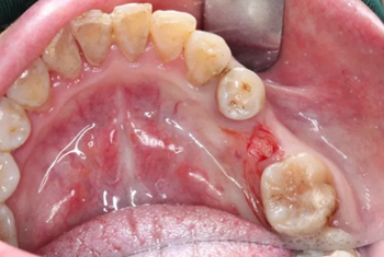 【病例分享】Implant Guide?數(shù)字化全程導航及椅旁即刻修復一例