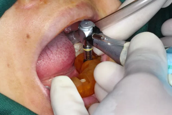 【病例分享】Implant Guide?數(shù)字化全程導航及椅旁即刻修復一例