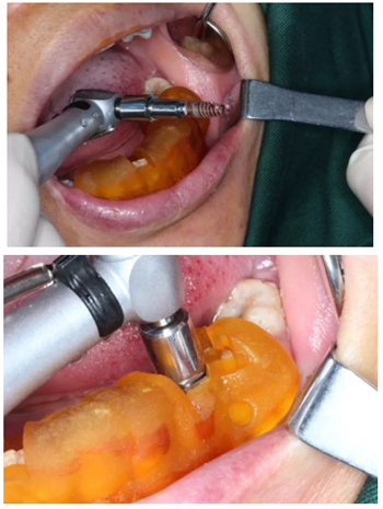 【病例分享】Implant Guide?數(shù)字化全程導航及椅旁即刻修復一例