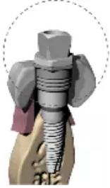 【病例分享】Implant Guide?數(shù)字化全程導航及椅旁即刻修復一例