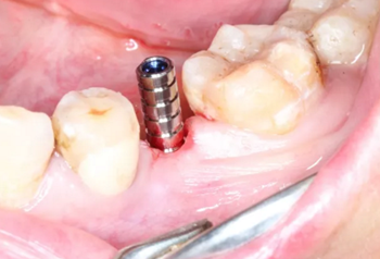 【病例分享】Implant Guide?數(shù)字化全程導航及椅旁即刻修復一例
