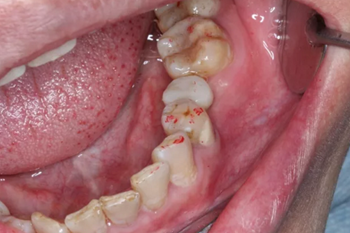 【病例分享】Implant Guide?數(shù)字化全程導航及椅旁即刻修復一例