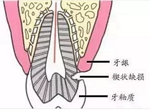 楔狀缺損是幾個意思 ?
