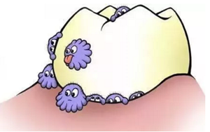楔狀缺損是幾個意思 ?