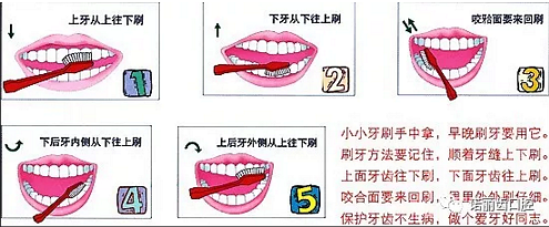 楔狀缺損是幾個意思 ?