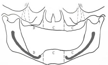 無(wú)牙頜種植修復(fù)的檢查與設(shè)計(jì)——施斌教授