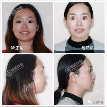 27歲嚴重齙牙，上下門牙牙根吸收嚴重，兩年矯正徹底蛻變，組建幸福家庭