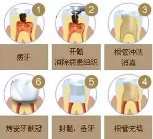 醫生，牙齒折斷不是應該補上去嗎，為啥要做根管治療？
