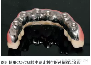 【經驗分享】無牙頜種植修復固位的并發癥與處理——宋應亮教授