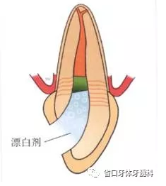 上前牙根管再治療后內漂白1例