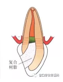 上前牙根管再治療后內漂白1例