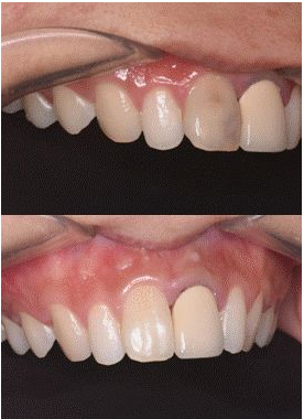 上前牙根管再治療后內漂白1例