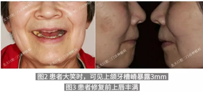 病例報道│全程數字化輔助無牙頜種植即刻負重