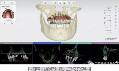 病例報道│全程數字化輔助無牙頜種植即刻負重