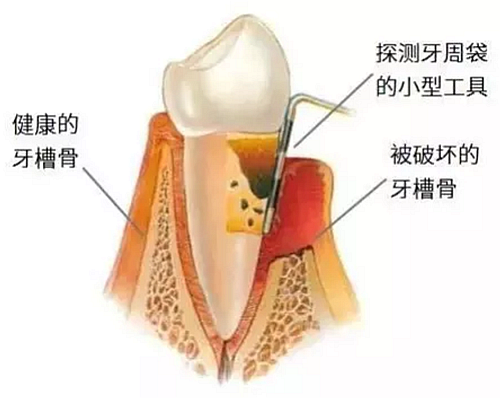 上海嘉?？谇谎芯克皇兰o牙周病的臨床進展