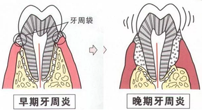 上海嘉?？谇谎芯克皇兰o牙周病的臨床進展