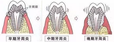上海嘉福口腔研究所二十一世紀牙周病的臨床進展