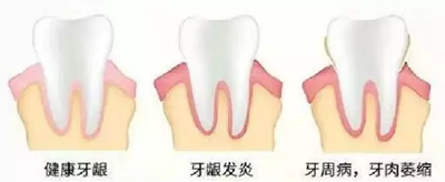 牙周炎，中國成年人后半生永遠的 痛 ！