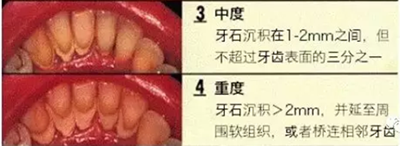 牙周炎，中國成年人后半生永遠的 痛 ！