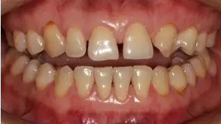 病例分享｜復合樹脂微創美學修復關閉上前牙間隙