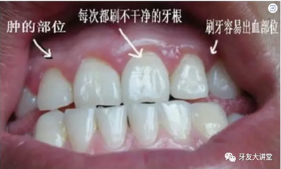 怎樣預防牙齦萎縮