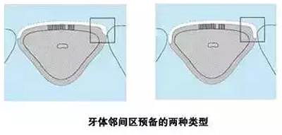 貼面備牙知多少？