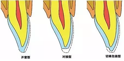 貼面備牙知多少？