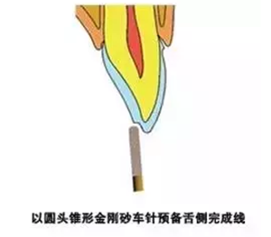 貼面備牙知多少？