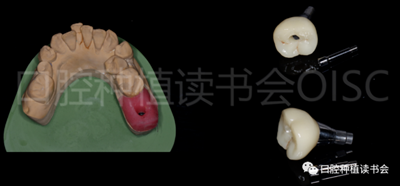 后牙區即刻種植臨床指南