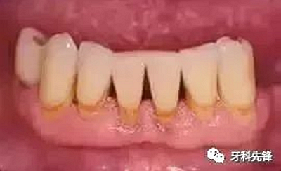 	牙齦萎縮是不治之癥？緩解牙齦萎縮5步走！