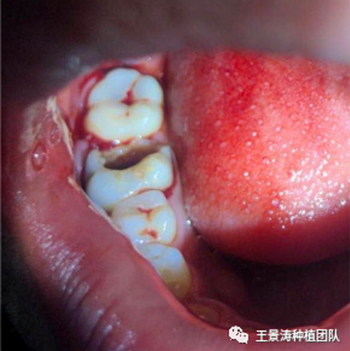 后牙區即刻種植的適應癥的思考