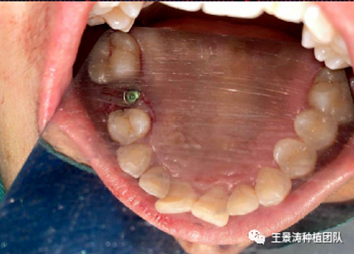 后牙區即刻種植的適應癥的思考