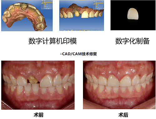 妙手牙醫丨殘根、殘冠還有保留的意義嗎？